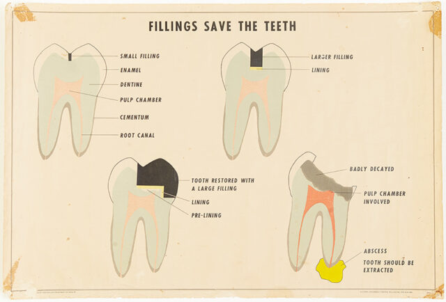 Diagrams of four teeth repaired in different ways